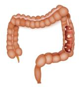 Côlon avec polypes